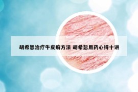 胡希恕治療牛皮癬方法 胡希恕用藥心得十講