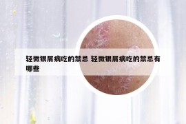 輕微銀屑病吃的禁忌 輕微銀屑病吃的禁忌有哪些