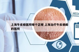 上海牛皮癬醫(yī)院哪個(gè)正規(guī) 上海治療牛皮病癬的醫(yī)院
