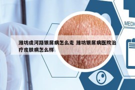 濰坊虞河路銀屑病怎么走 濰坊銀屑病醫(yī)院治療皮膚病怎么樣
