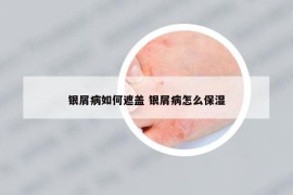 銀屑病如何遮蓋 銀屑病怎么保濕