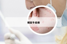 裸鼠牛皮癬