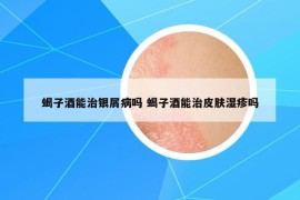 蝎子酒能治銀屑病嗎 蝎子酒能治皮膚濕疹嗎