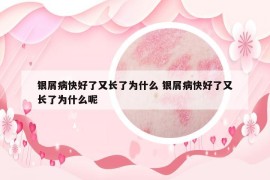 銀屑病快好了又長(zhǎng)了為什么 銀屑病快好了又長(zhǎng)了為什么呢