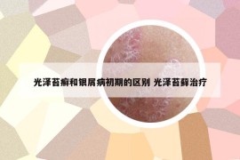 光澤苔癬和銀屑病初期的區(qū)別 光澤苔蘚治療