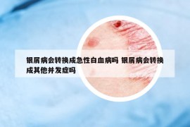 銀屑病會轉(zhuǎn)換成急性白血病嗎 銀屑病會轉(zhuǎn)換成其他并發(fā)癥嗎