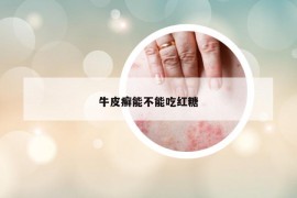 牛皮癬能不能吃紅糖