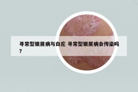 尋常型銀屑病與白庀 尋常型銀屑病會(huì)傳染嗎?