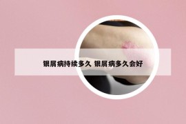 銀屑病持續(xù)多久 銀屑病多久會(huì)好