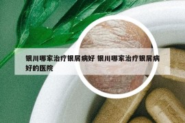 銀川哪家治療銀屑病好 銀川哪家治療銀屑病好的醫(yī)院