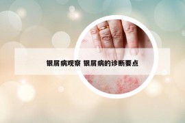 銀屑病觀察 銀屑病的診斷要點(diǎn)