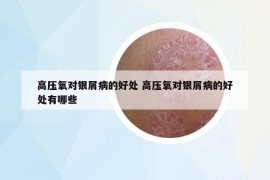 高壓氧對(duì)銀屑病的好處 高壓氧對(duì)銀屑病的好處有哪些