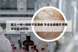 腿上一塊一塊的干皮像癬 牛皮皮癬圖片早期癥狀能治好嗎