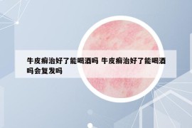 牛皮癬治好了能喝酒嗎 牛皮癬治好了能喝酒嗎會(huì)復(fù)發(fā)嗎