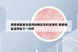 銀屑病患者會(huì)遺傳給剛出生的寶寶嗎 銀屑病能遺傳給下一代嗎