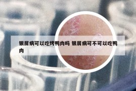 銀屑病可以吃烤鴨肉嗎 銀屑病可不可以吃鴨肉