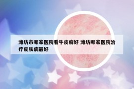 濰坊市哪家醫(yī)院看牛皮癬好 濰坊哪家醫(yī)院治療皮膚病最好