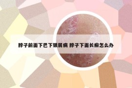 脖子前面下巴下銀屑病 脖子下面長癬怎么辦