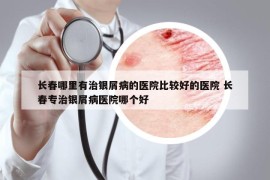 長春哪里有治銀屑病的醫(yī)院比較好的醫(yī)院 長春專治銀屑病醫(yī)院哪個好