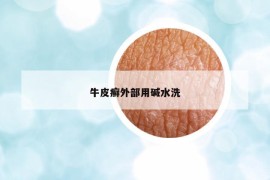 牛皮癬外部用堿水洗