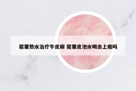 罌粟熬水治療牛皮癬 罌粟皮泡水喝會上癮嗎
