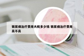 銀屑病治療費用大概多少錢 銀屑病治療費用高不高