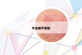 牛皮癬蘆薈膠