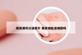 銀屑病可以請假不 銀屑病能請病假嗎