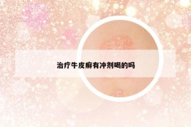 治療牛皮癬有沖劑喝的嗎