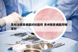 貴陽治銀屑病最好的醫(yī)院 貴州銀屑病醫(yī)院哪家好