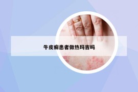 牛皮癬患者做熱瑪吉嗎