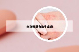 南京哪里有治牛皮癬