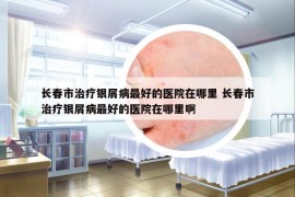 長春市治療銀屑病最好的醫(yī)院在哪里 長春市治療銀屑病最好的醫(yī)院在哪里啊