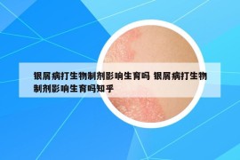 銀屑病打生物制劑影響生育嗎 銀屑病打生物制劑影響生育嗎知乎