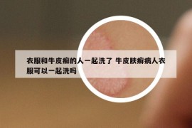 衣服和牛皮癬的人一起洗了 牛皮膚癬病人衣服可以一起洗嗎