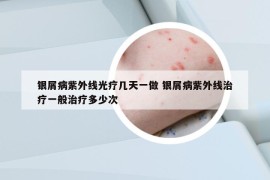 銀屑病紫外線光療幾天一做 銀屑病紫外線治療一般治療多少次