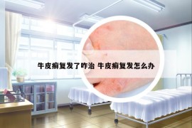 牛皮癬復(fù)發(fā)了咋治 牛皮癬復(fù)發(fā)怎么辦