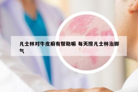 凡士林對(duì)牛皮癬有幫助嘛 每天擦凡士林治腳氣