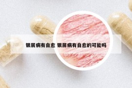 銀屑病有自愈 銀屑病有自愈的可能嗎