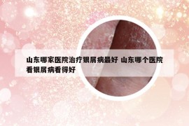 山東哪家醫(yī)院治療銀屑病最好 山東哪個醫(yī)院看銀屑病看得好