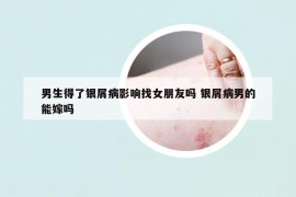 男生得了銀屑病影響找女朋友嗎 銀屑病男的能嫁嗎
