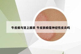 牛皮癬與腎上腺素 牛皮膚癬是神經(jīng)性皮炎嗎
