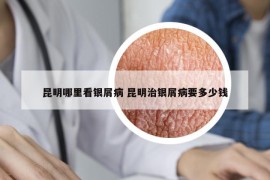 昆明哪里看銀屑病 昆明治銀屑病要多少錢