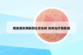 銀屑病生物制劑北京協(xié)和 協(xié)和治療銀屑病
