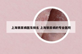 上海銀屑病醫(yī)生排名 上海銀屑病的專業(yè)醫(yī)院