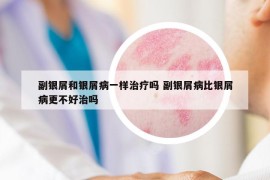 副銀屑和銀屑病一樣治療嗎 副銀屑病比銀屑病更不好治嗎