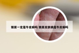銀屑一定是牛皮癬嗎 銀屑皮膚病是牛皮癬嗎