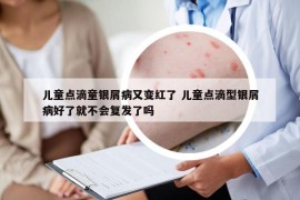 兒童點(diǎn)滴童銀屑病又變紅了 兒童點(diǎn)滴型銀屑病好了就不會(huì)復(fù)發(fā)了嗎