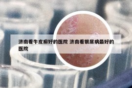 濟(jì)南看牛皮癬好的醫(yī)院 濟(jì)南看銀屑病最好的醫(yī)院