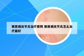 銀屑病關(guān)節(jié)炎治療原則 銀屑病關(guān)節(jié)炎怎么治療最好